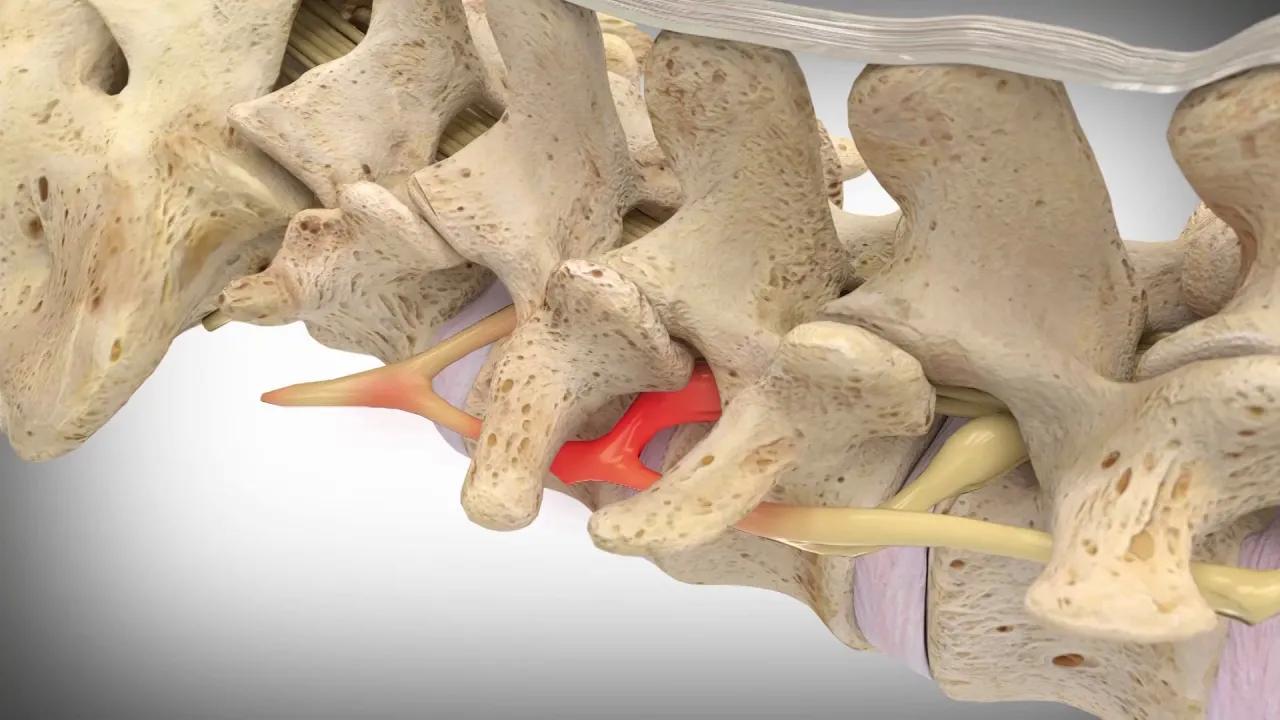 Vertiflex® Spine Treatment Interspinous Spacer Surgery