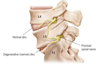 lumbar foramen