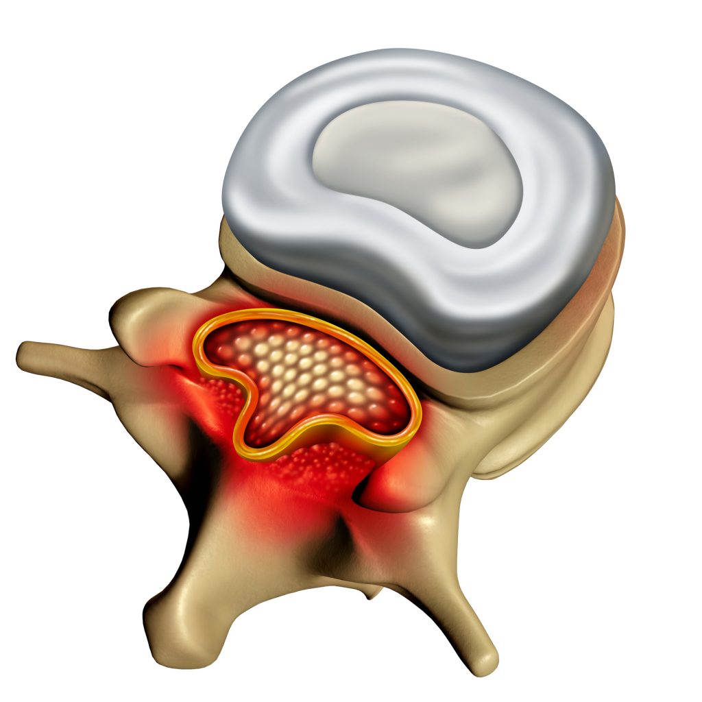 A Cold Sensation Traveling Down Your Legs: Another Strange MS