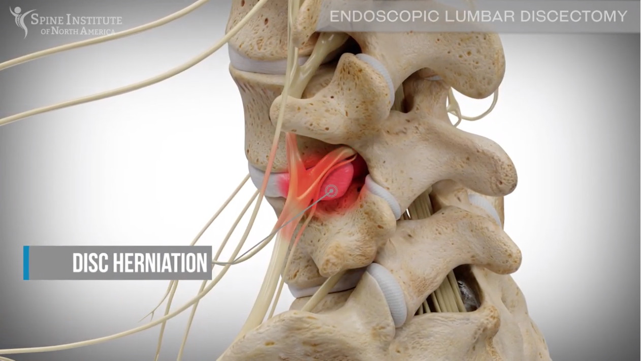 Endoscopic Discectomy Procedure: Learn What to Expect