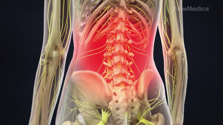 Pinched nerve in lower back: How to tell, causes, and treatments
