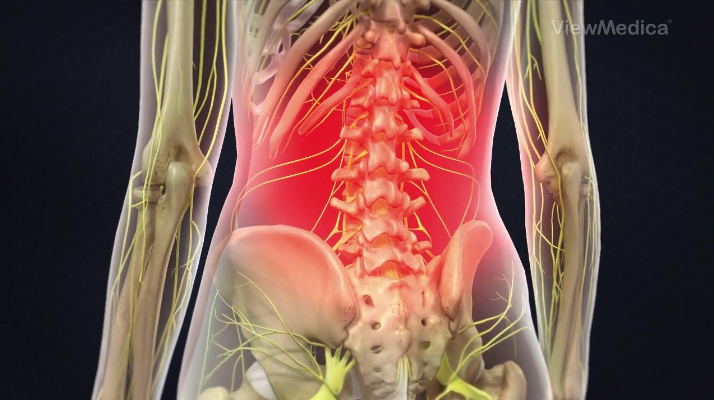 Pinched Nerve in Lower Back: Causes, Symptoms, and Treatments